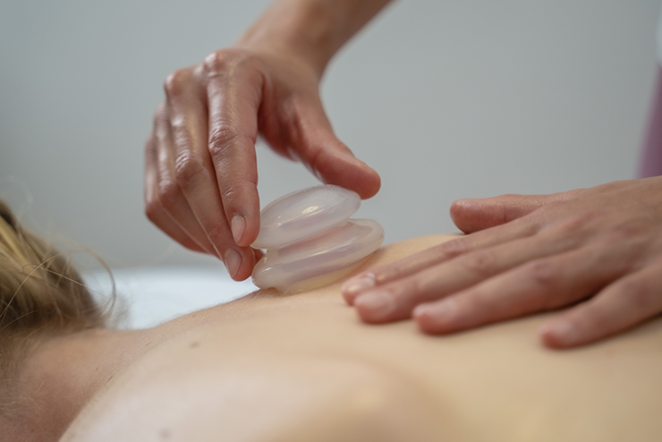 cupping ng